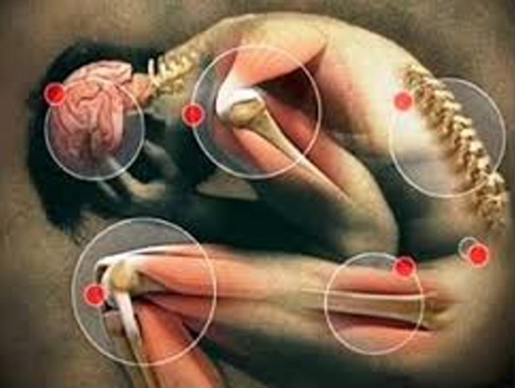 Thumbnail for blog Fundação do grupo de Pacientes Reumáticos do Sul de Minas